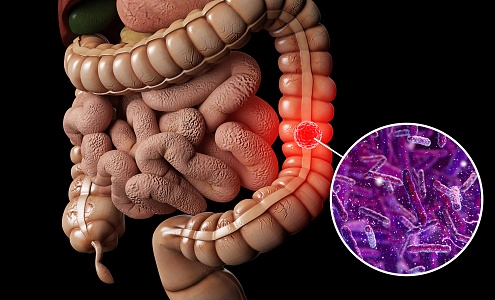 Modern human bowel cancer 3d model