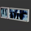 Medical X-ray Illuminators With Clear Display Of Lung And Bone Implant Films