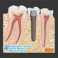 Dental Implant Medical Device With Tooth Structure And Bone Model