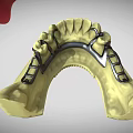 Detailed Dental Organ Prosthesis Models Featuring Crowns Bridges Abutments And Arch Structures