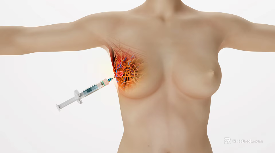 Medical Device Syringe Used In Breast Injection Procedure With Internal Tissue Structure 3d model