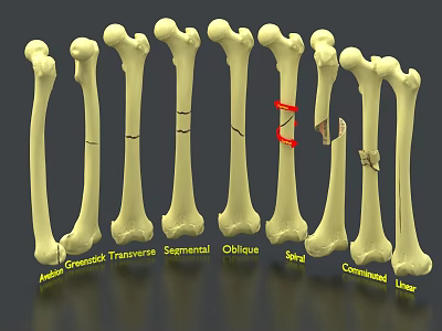 Decorative Ornament Set with Various Fracture Types Bone Models for Medical Theme 3d model